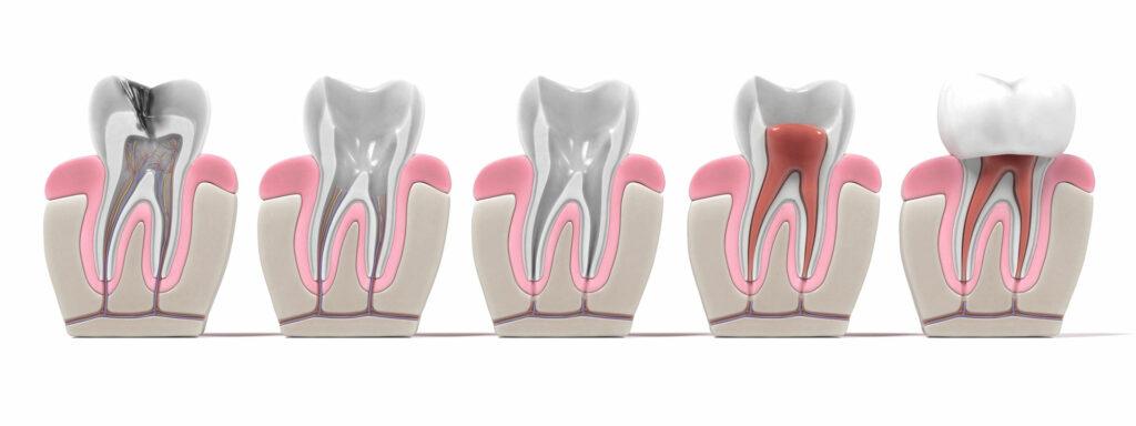 Endodonzia