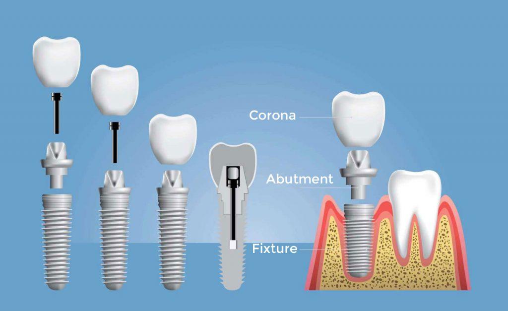 schema impianto dentale