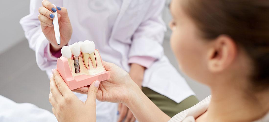Cos'è un impianto dentale