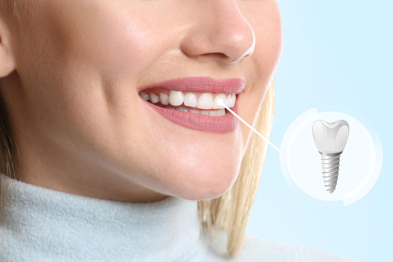 impianto dentale sorriso