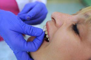 Applicazione delle faccette dentali