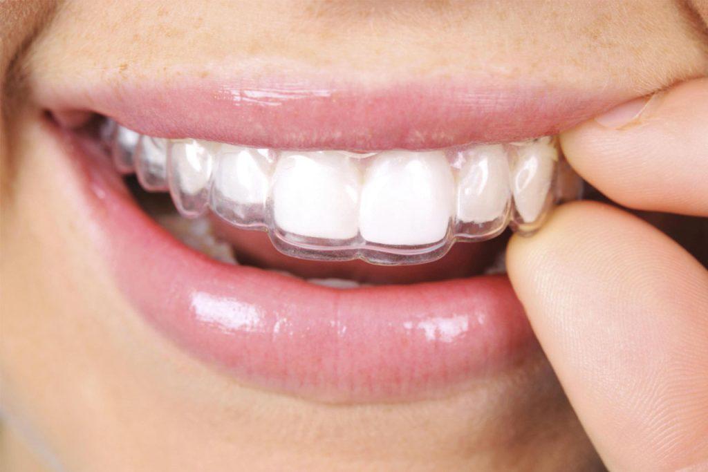 Invisalign® e la tecnologia che utilizza allineatori trasparenti personalizzati