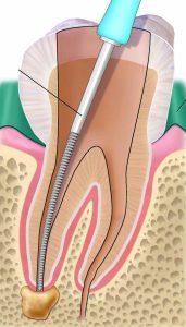 Cura canalare e devitalizzazione dente