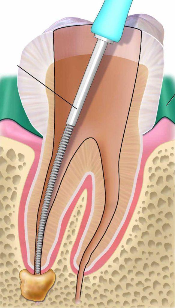 la-devitalizzazione-dentaria-endodonzia-milano-sesto-s-giovanni