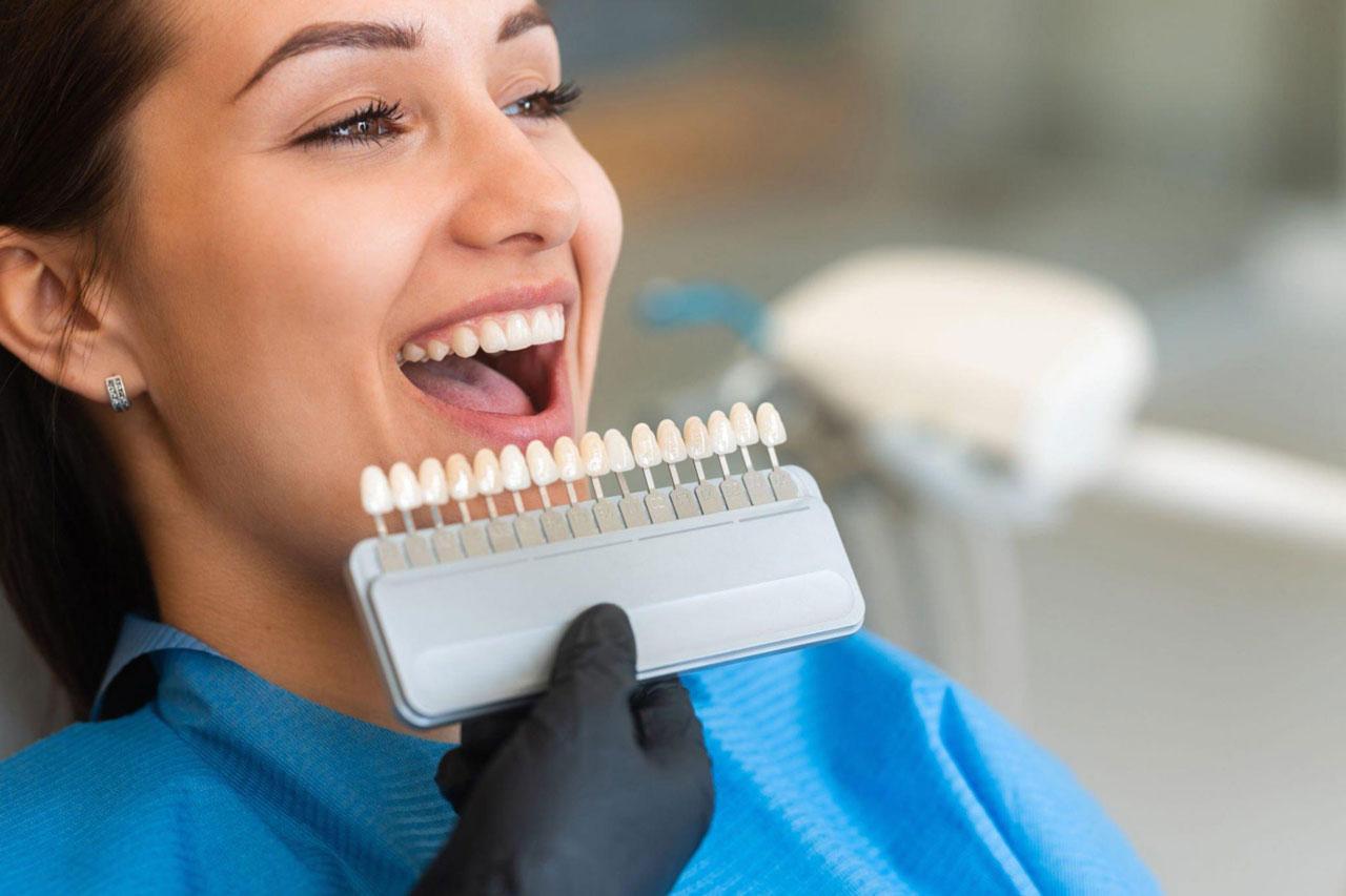 Faccette dentali dei VIP