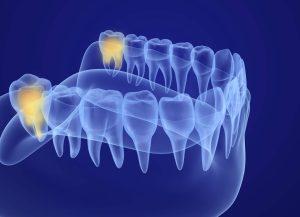 Posizione denti del giudizio