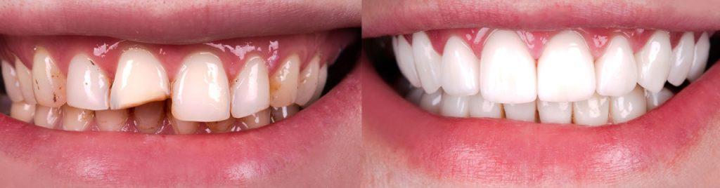 Veneers prima e dopo