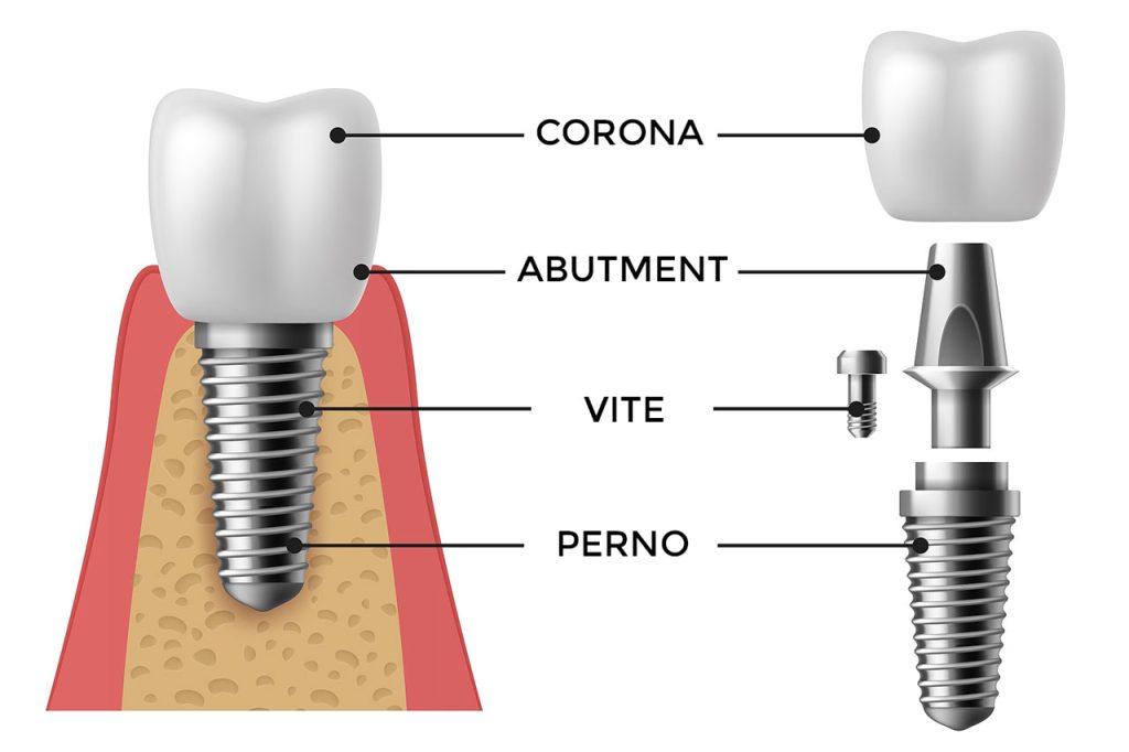 Un impianto dentale schematizzato